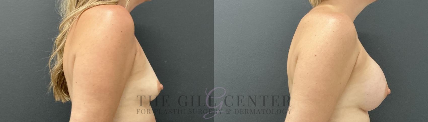 Breast Augmentation Case 815 Before & After Right Side | The Woodlands, TX | The Gill Center for Plastic Surgery and Dermatology