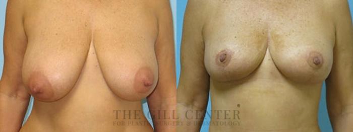 Breast Lift Case 430 Before & After Front | The Woodlands, TX | The Gill Center for Plastic Surgery and Dermatology
