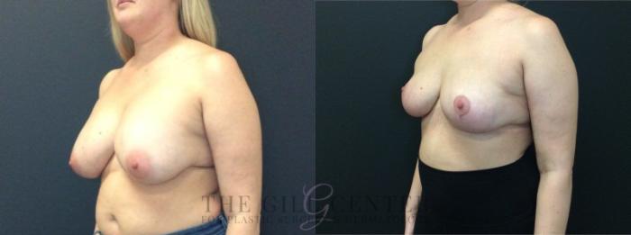Breast Lift Case 451 Before & After Left Oblique | The Woodlands, TX | The Gill Center for Plastic Surgery and Dermatology