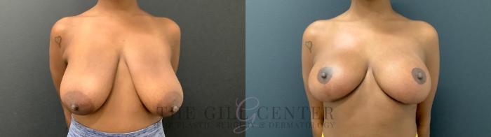Breast Lift Case 491 Before & After Front | The Woodlands, TX | The Gill Center for Plastic Surgery and Dermatology