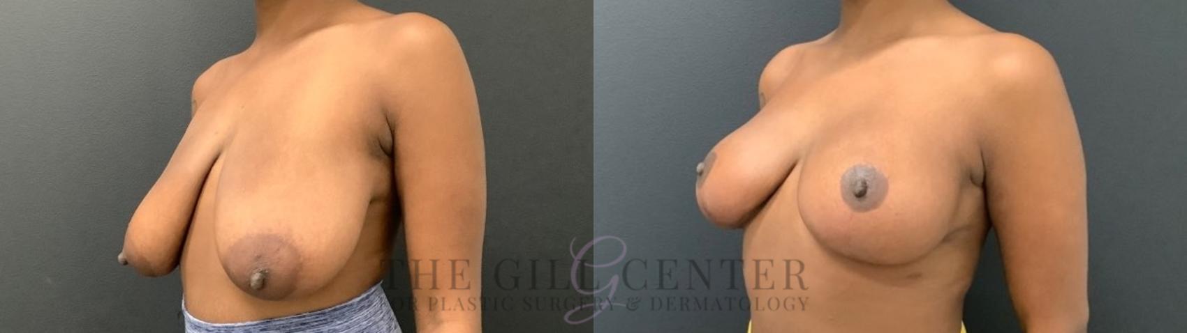 Breast Lift Case 491 Before & After Left Oblique | The Woodlands, TX | The Gill Center for Plastic Surgery and Dermatology