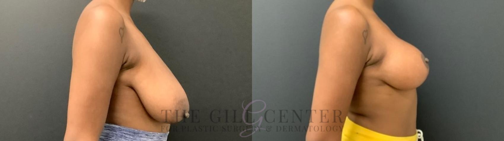Breast Lift Case 491 Before & After Right Side | The Woodlands, TX | The Gill Center for Plastic Surgery and Dermatology