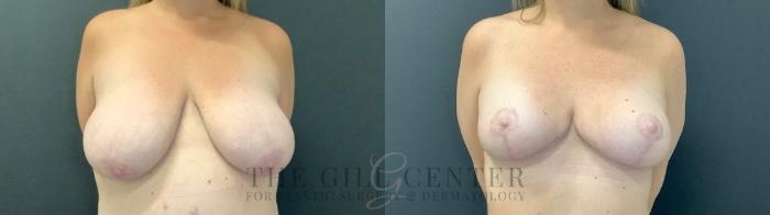 Breast Lift Case 495 Before & After Front | The Woodlands, TX | The Gill Center for Plastic Surgery and Dermatology