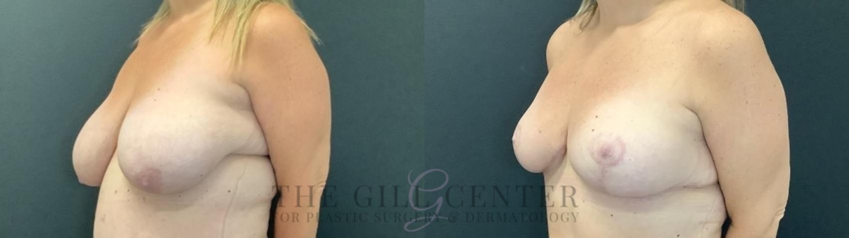 Breast Lift Case 495 Before & After Left Oblique | The Woodlands, TX | The Gill Center for Plastic Surgery and Dermatology