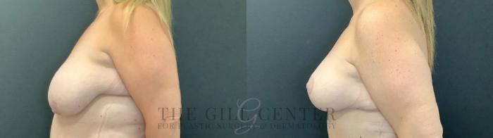 Breast Lift Case 495 Before & After Left Side | The Woodlands, TX | The Gill Center for Plastic Surgery and Dermatology