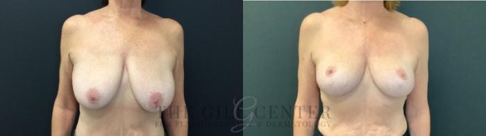 Breast Lift Case 509 Before & After Front | The Woodlands, TX | The Gill Center for Plastic Surgery and Dermatology