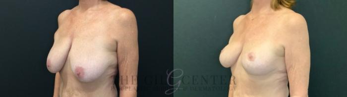 Breast Lift Case 509 Before & After Left Oblique | The Woodlands, TX | The Gill Center for Plastic Surgery and Dermatology