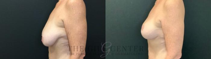 Breast Lift Case 509 Before & After Left Side | The Woodlands, TX | The Gill Center for Plastic Surgery and Dermatology