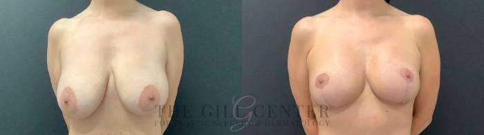 Breast Lift Case 580 Before & After Front | The Woodlands, TX | The Gill Center for Plastic Surgery and Dermatology