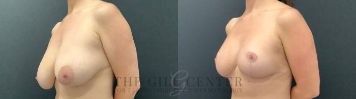 Breast Lift Case 580 Before & After Left Oblique | The Woodlands, TX | The Gill Center for Plastic Surgery and Dermatology