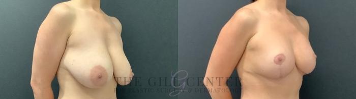Breast Lift Case 580 Before & After Right Oblique | The Woodlands, TX | The Gill Center for Plastic Surgery and Dermatology