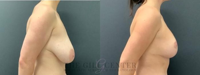 Breast Lift Case 580 Before & After Right Side | The Woodlands, TX | The Gill Center for Plastic Surgery and Dermatology