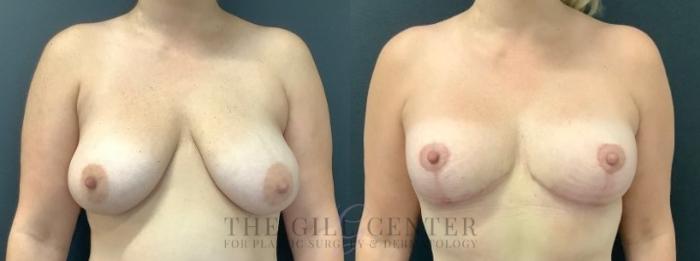 Breast Lift Case 611 Before & After Front | The Woodlands, TX | The Gill Center for Plastic Surgery and Dermatology