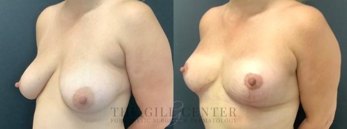 Breast Lift Case 611 Before & After Left Oblique | The Woodlands, TX | The Gill Center for Plastic Surgery and Dermatology