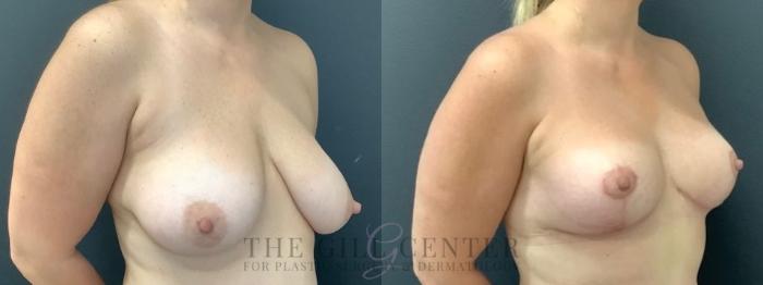Breast Lift Case 611 Before & After Right Oblique | The Woodlands, TX | The Gill Center for Plastic Surgery and Dermatology