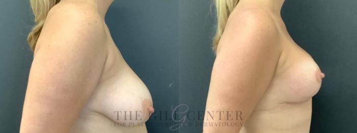 Breast Lift Case 611 Before & After Right Side | The Woodlands, TX | The Gill Center for Plastic Surgery and Dermatology