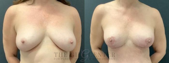 Breast Lift Case 616 Before & After Front | The Woodlands, TX | The Gill Center for Plastic Surgery and Dermatology