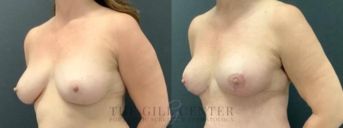 Breast Lift Case 616 Before & After Left Oblique | The Woodlands, TX | The Gill Center for Plastic Surgery and Dermatology