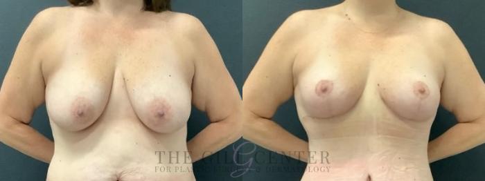 Breast Lift Case 640 Before & After Front | The Woodlands, TX | The Gill Center for Plastic Surgery and Dermatology