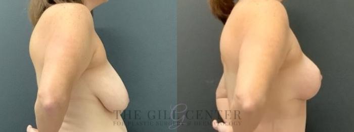 Breast Lift Case 640 Before & After Right Side | The Woodlands, TX | The Gill Center for Plastic Surgery and Dermatology