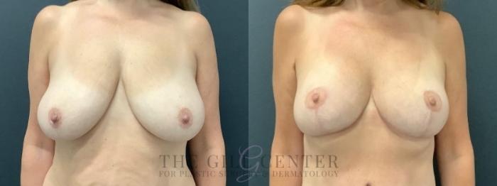 Breast Lift Case 641 Before & After Front | The Woodlands, TX | The Gill Center for Plastic Surgery and Dermatology