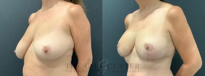 Breast Lift Case 641 Before & After Left Oblique | The Woodlands, TX | The Gill Center for Plastic Surgery and Dermatology