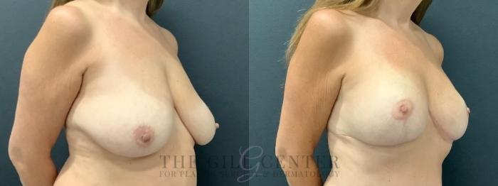 Breast Lift Case 641 Before & After Right Oblique | The Woodlands, TX | The Gill Center for Plastic Surgery and Dermatology