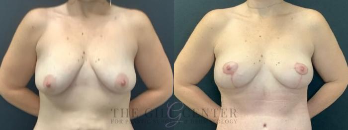 Breast Lift Case 642 Before & After Front | The Woodlands, TX | The Gill Center for Plastic Surgery and Dermatology