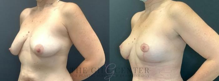 Breast Lift Case 642 Before & After Left Oblique | The Woodlands, TX | The Gill Center for Plastic Surgery and Dermatology