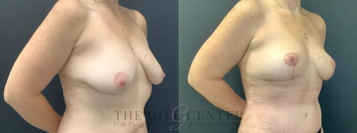 Breast Lift Case 642 Before & After Right Oblique | The Woodlands, TX | The Gill Center for Plastic Surgery and Dermatology
