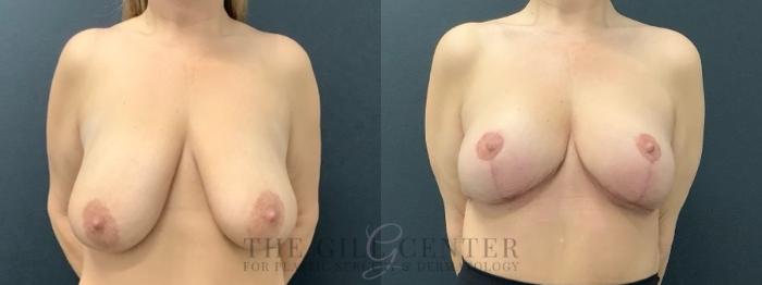 Breast Lift Case 643 Before & After Front | The Woodlands, TX | The Gill Center for Plastic Surgery and Dermatology