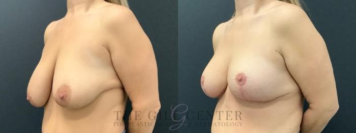 Breast Lift Case 643 Before & After Left Oblique | The Woodlands, TX | The Gill Center for Plastic Surgery and Dermatology