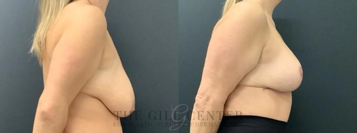 Breast Lift Case 643 Before & After Right Side | The Woodlands, TX | The Gill Center for Plastic Surgery and Dermatology