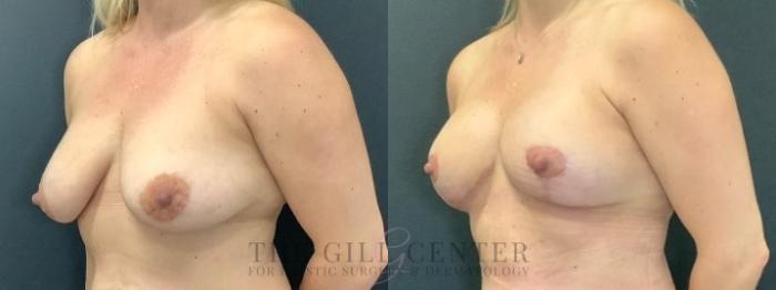 Breast Lift Case 650 Before & After Left Oblique | The Woodlands, TX | The Gill Center for Plastic Surgery and Dermatology