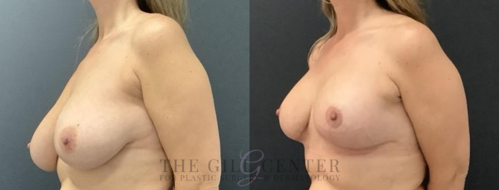 Breast Lift Case 688 Before & After Left Side | The Woodlands, TX | The Gill Center for Plastic Surgery and Dermatology