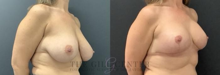 Breast Lift Case 688 Before & After Right Side | The Woodlands, TX | The Gill Center for Plastic Surgery and Dermatology
