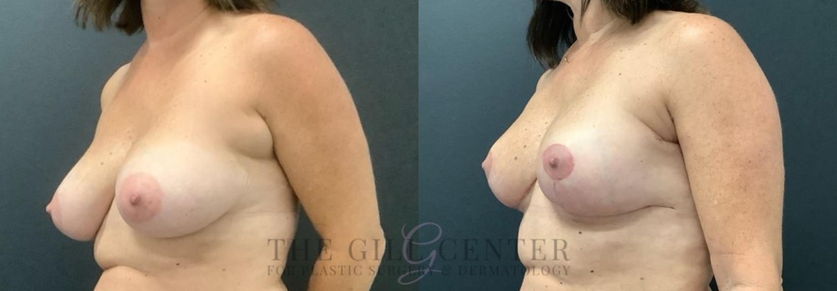 Breast Lift Case 693 Before & After Left Side | The Woodlands, TX | The Gill Center for Plastic Surgery and Dermatology