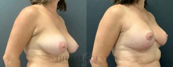 Breast Lift Case 693 Before & After Right Side | The Woodlands, TX | The Gill Center for Plastic Surgery and Dermatology