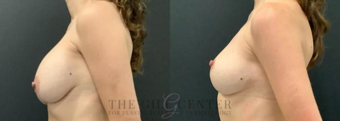Breast Lift Case 731 Before & After Left Side | The Woodlands, TX | The Gill Center for Plastic Surgery and Dermatology