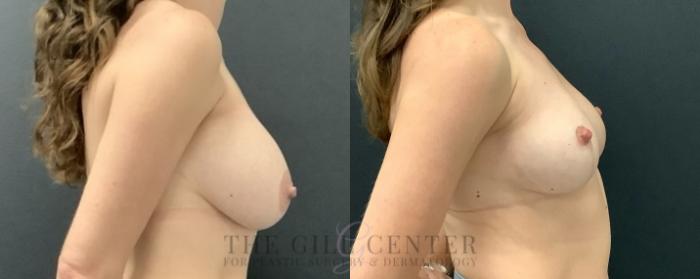 Breast Lift Case 731 Before & After Right Side | The Woodlands, TX | The Gill Center for Plastic Surgery and Dermatology
