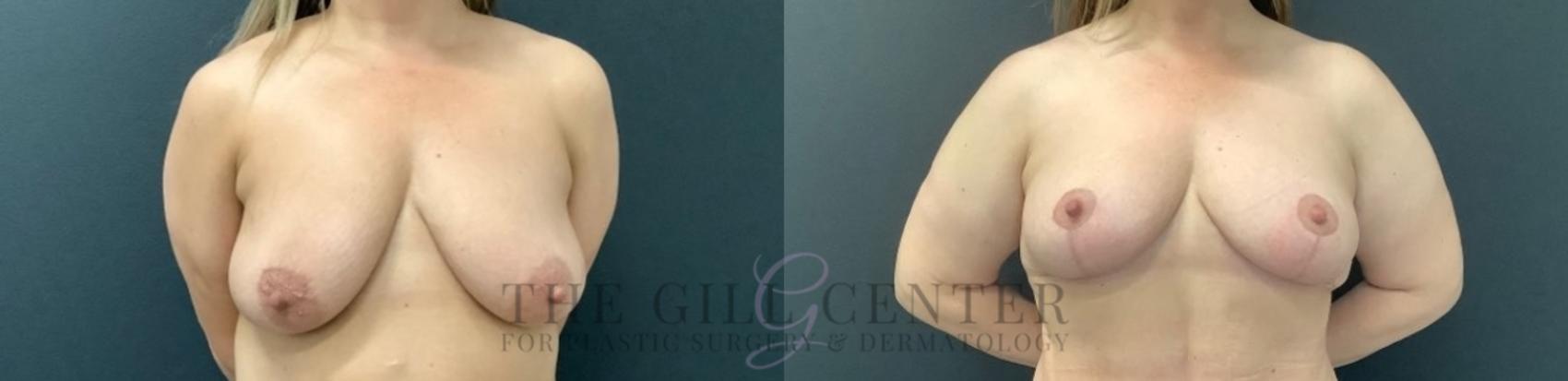 Breast Lift Case 744 Before & After Front | The Woodlands, TX | The Gill Center for Plastic Surgery and Dermatology