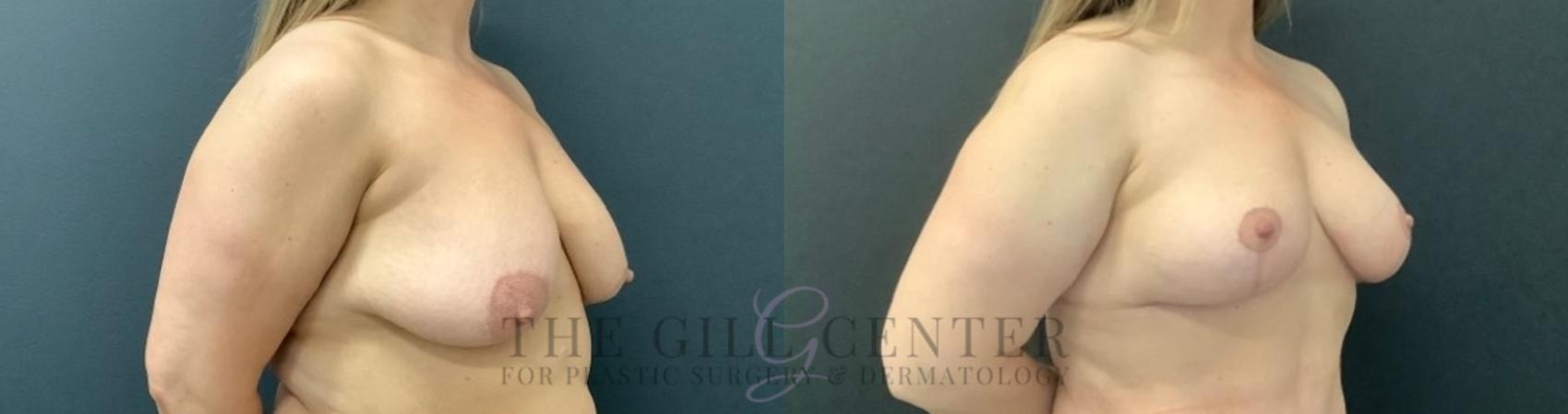 Breast Lift Case 744 Before & After Right Oblique | The Woodlands, TX | The Gill Center for Plastic Surgery and Dermatology