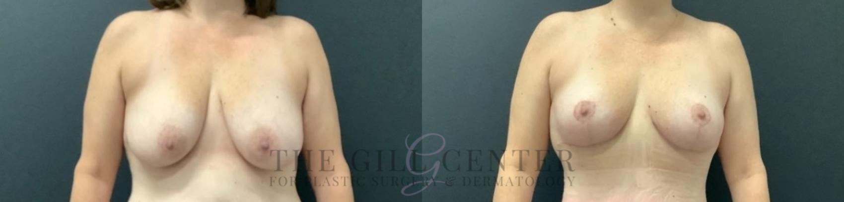 Breast Lift Case 745 Before & After Front | The Woodlands, TX | The Gill Center for Plastic Surgery and Dermatology