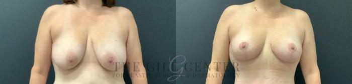 Breast Lift Case 745 Before & After Front | The Woodlands, TX | The Gill Center for Plastic Surgery and Dermatology