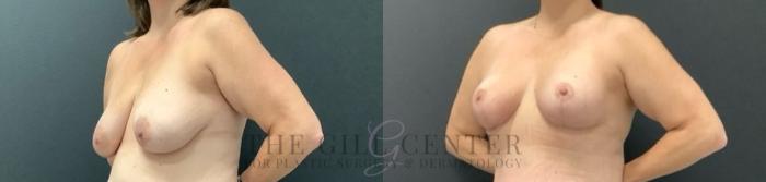 Breast Lift Case 745 Before & After Left Oblique | The Woodlands, TX | The Gill Center for Plastic Surgery and Dermatology