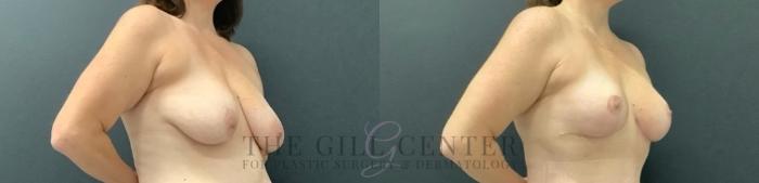 Breast Lift Case 745 Before & After Right Oblique | The Woodlands, TX | The Gill Center for Plastic Surgery and Dermatology