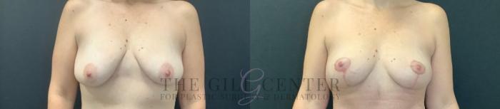 Breast Lift Case 746 Before & After Front | The Woodlands, TX | The Gill Center for Plastic Surgery and Dermatology