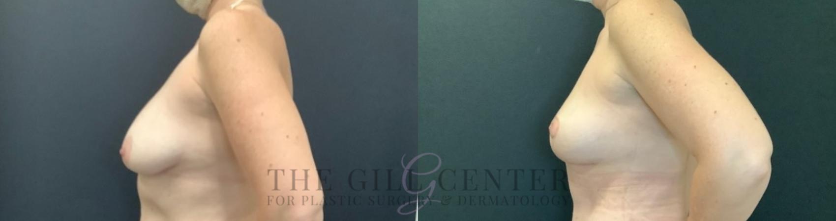 Breast Lift Case 746 Before & After Left Side | The Woodlands, TX | The Gill Center for Plastic Surgery and Dermatology