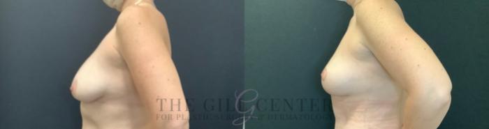 Breast Lift Case 746 Before & After Left Side | The Woodlands, TX | The Gill Center for Plastic Surgery and Dermatology