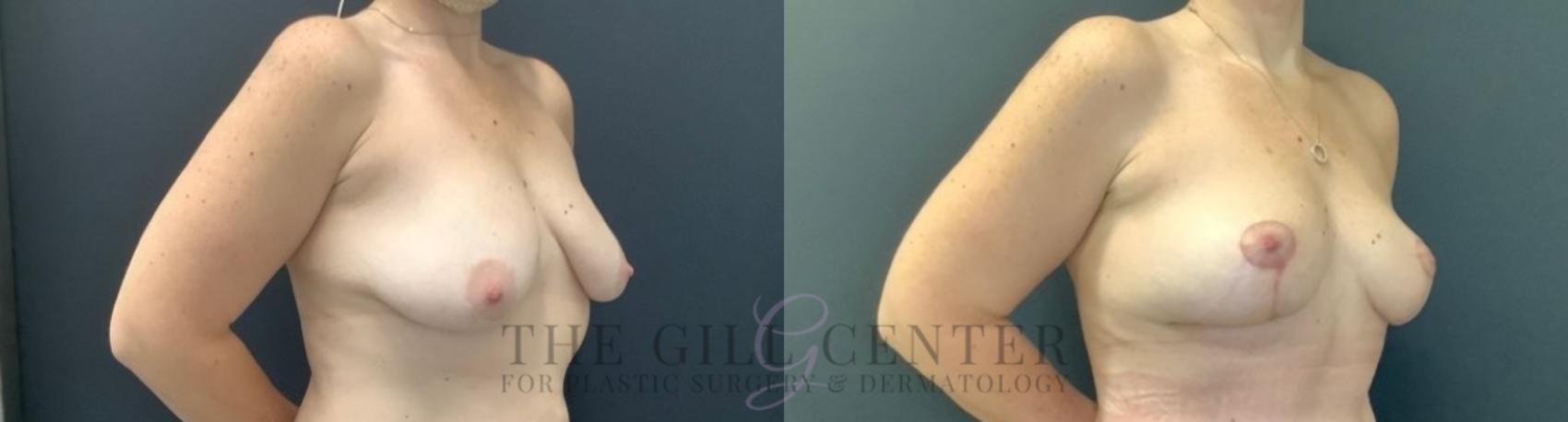 Breast Lift Case 746 Before & After Right Oblique | The Woodlands, TX | The Gill Center for Plastic Surgery and Dermatology